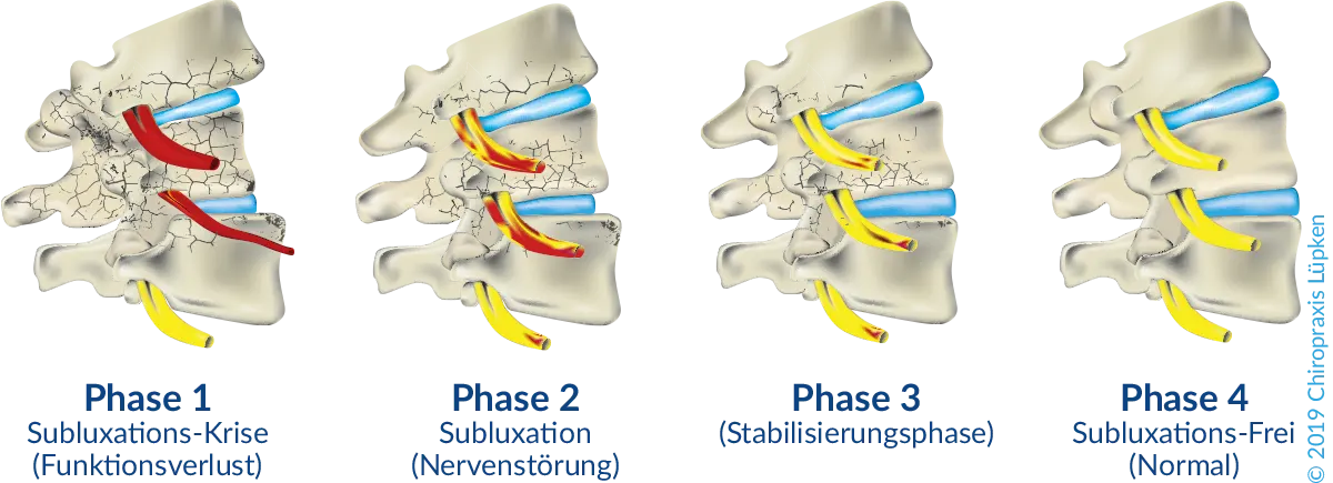 Subluxation und Normalzustand eines Wirbelkörpers