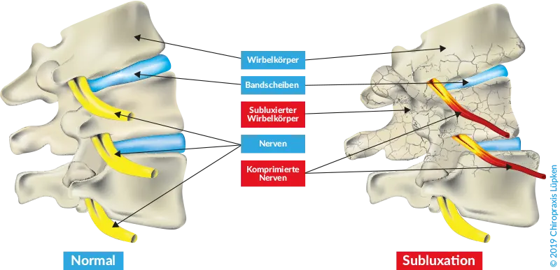 Normalzustand und Subluxation eines Wirbelkörpers